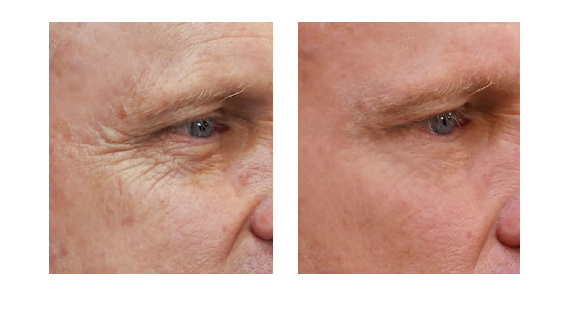 Jeff's crow's feet before and after treatment