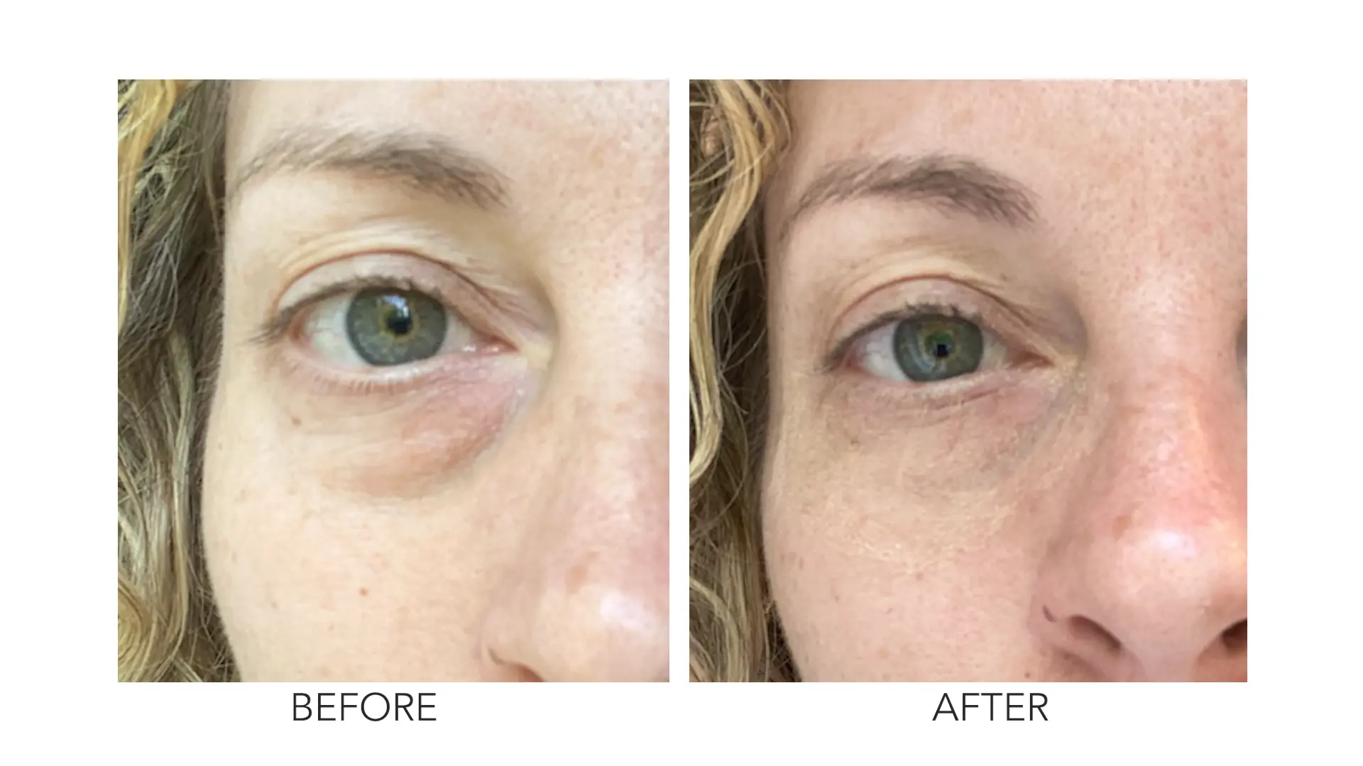 Close-up of Angie's under-eye puffiness before and after