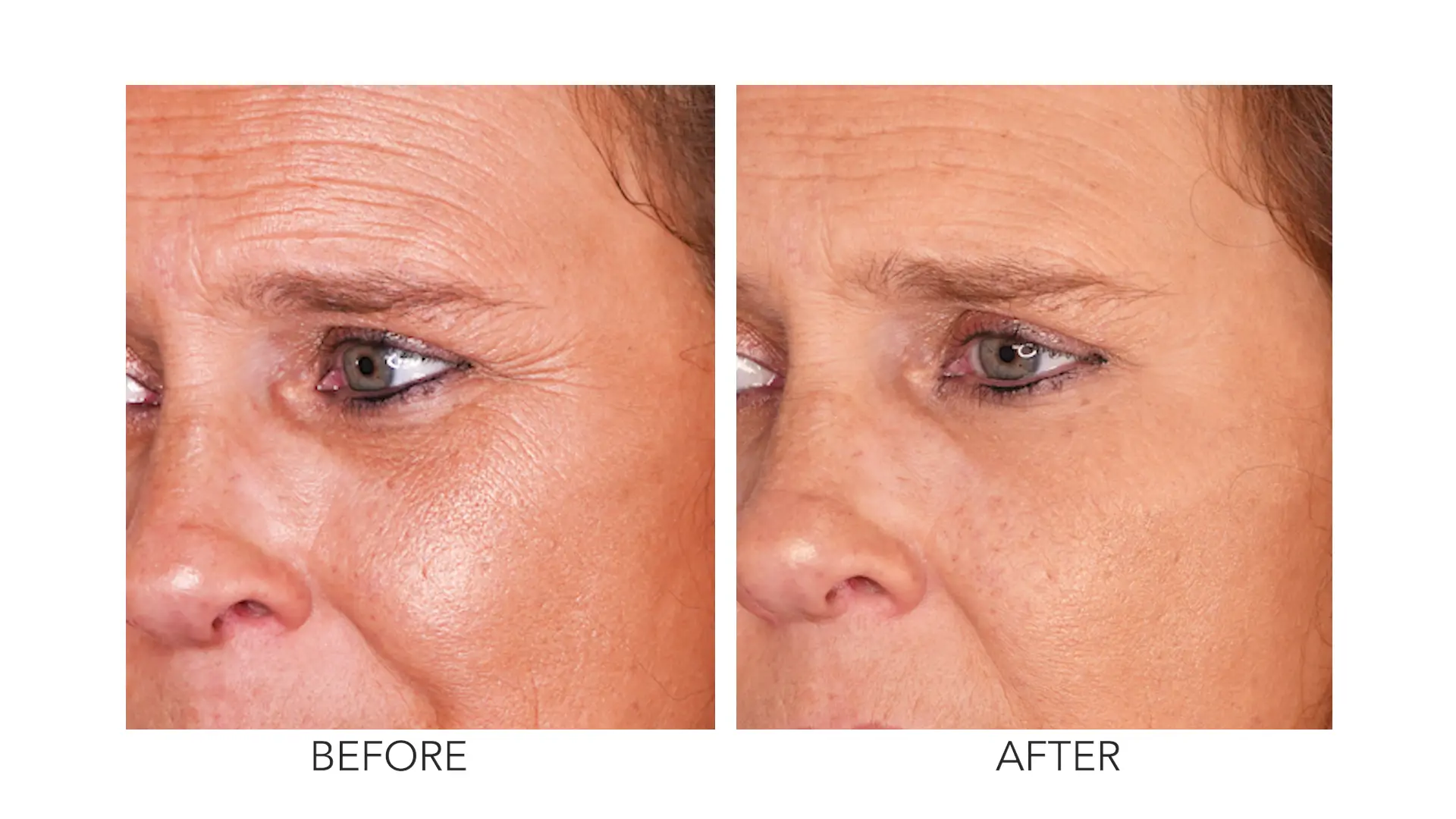 Beverly's crow's feet before and after treatment