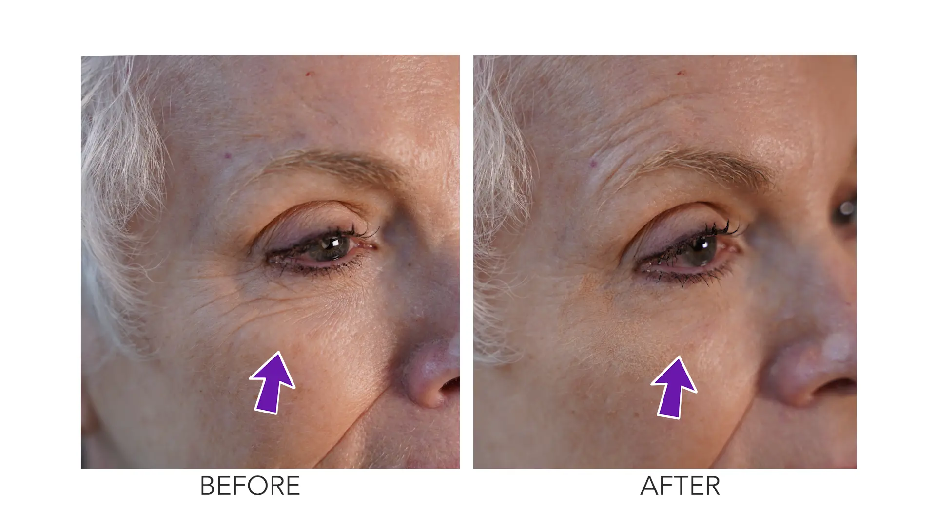 Ellen's under-eye lines before and after treatment