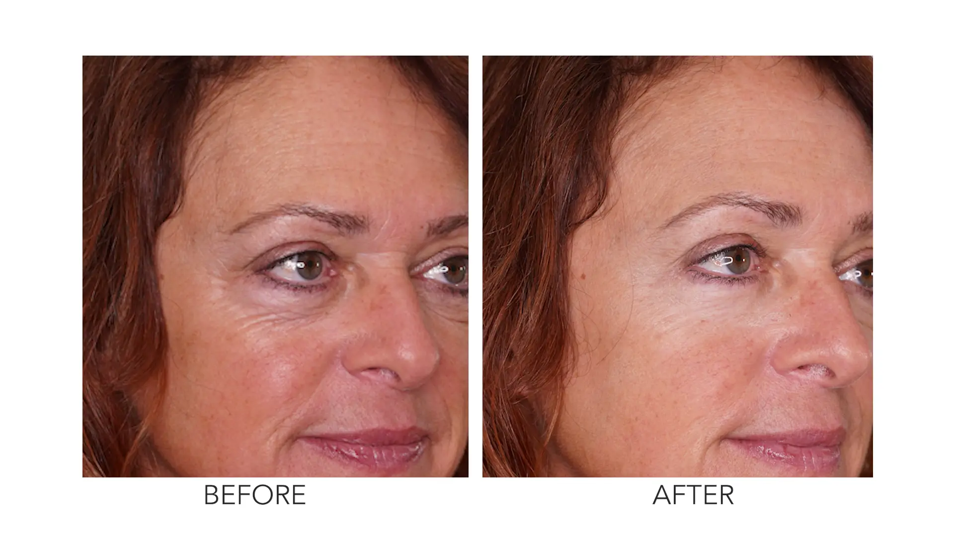 Gina's eye area before and after treatment