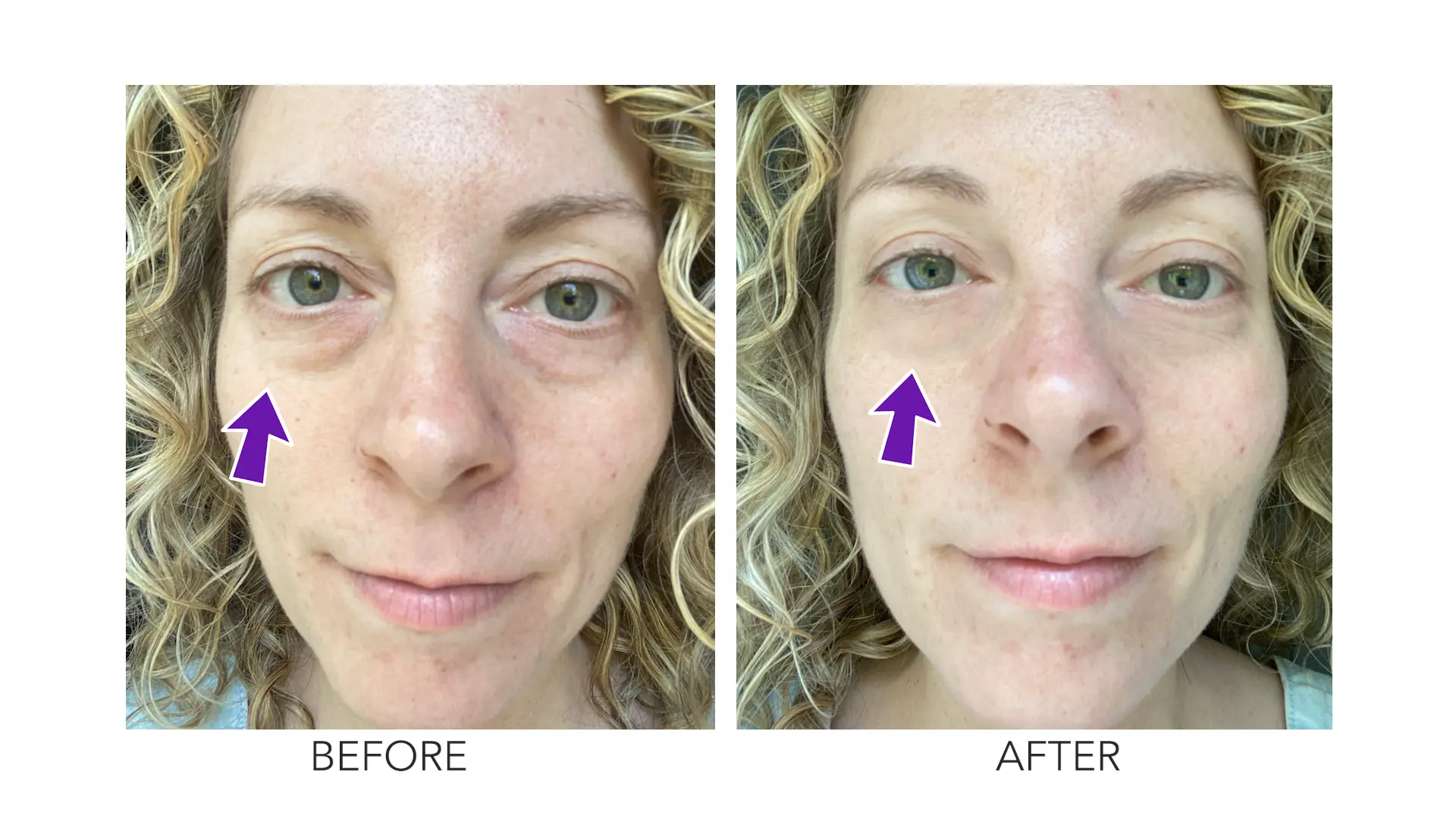 Angie's under-eye bags before and after treatment